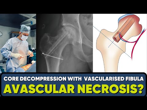 Avascular Necrosis