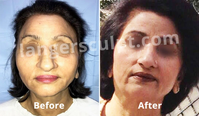 Non-Surgical