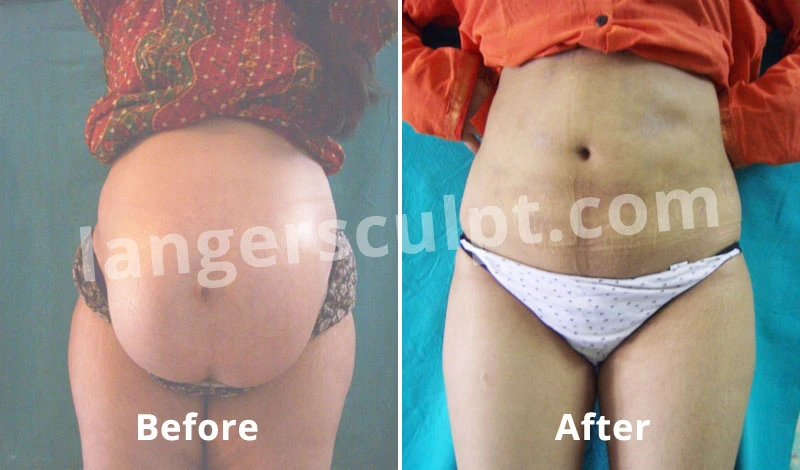 Tummy Tuck