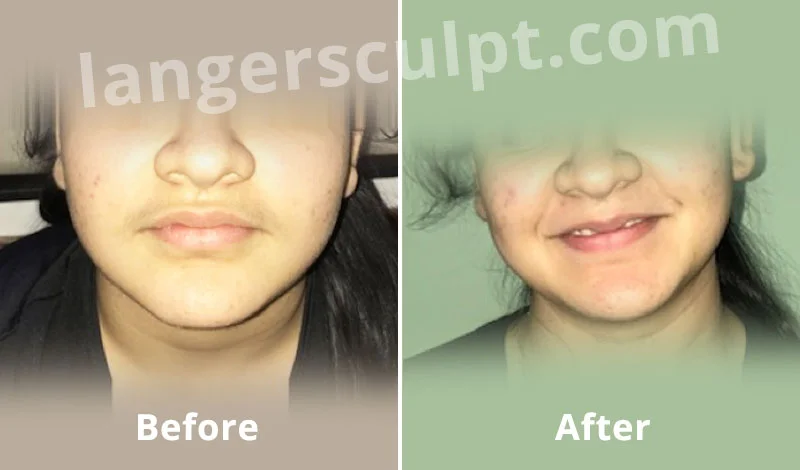 Laser Hair Reduction for Facial hair