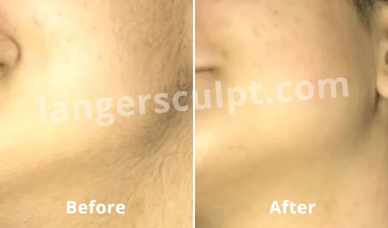 Laser Hair Reduction for Facial hair