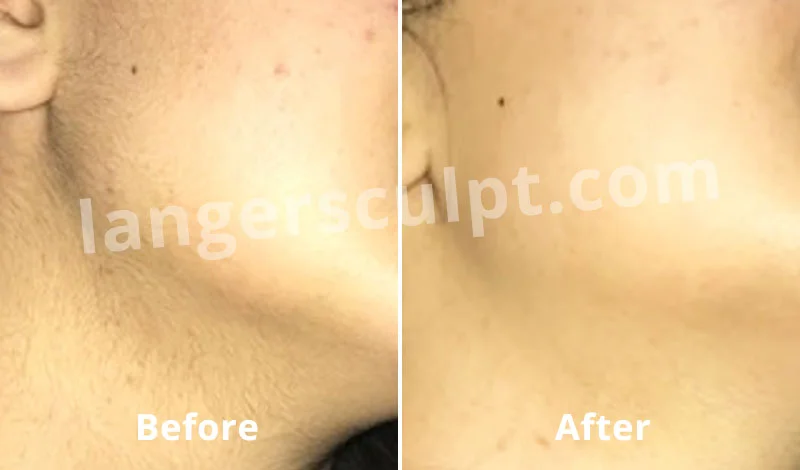 Laser Hair Reduction for Facial hair