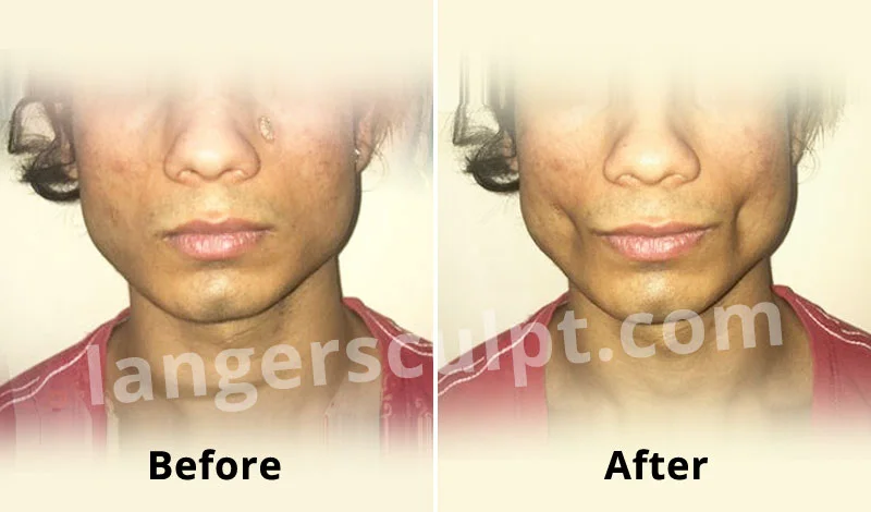 Buccal fat pad reduction for a sunken, lean look for the cheeks