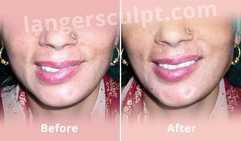 Botox for Lip and smile asymmetry