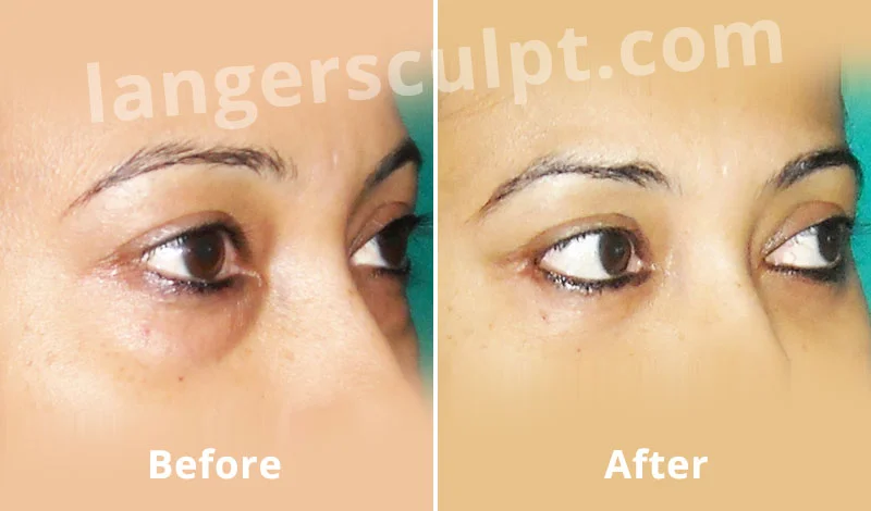 Upper and Lower Blepharoplasty or Eyelid job for the tired, baggy eye look