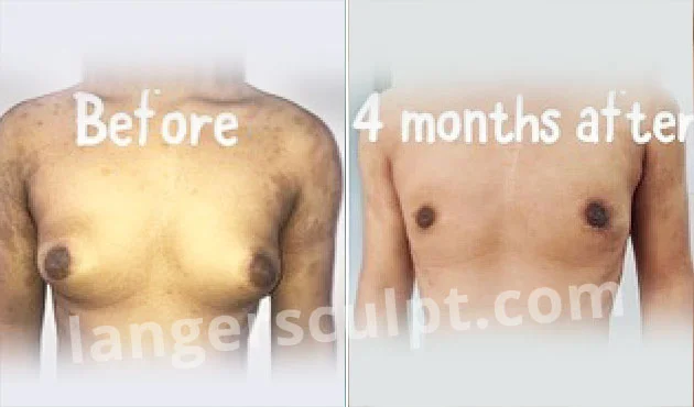 Gynecomastia Correction Surgery