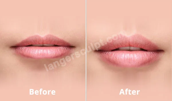 Lip Fillers