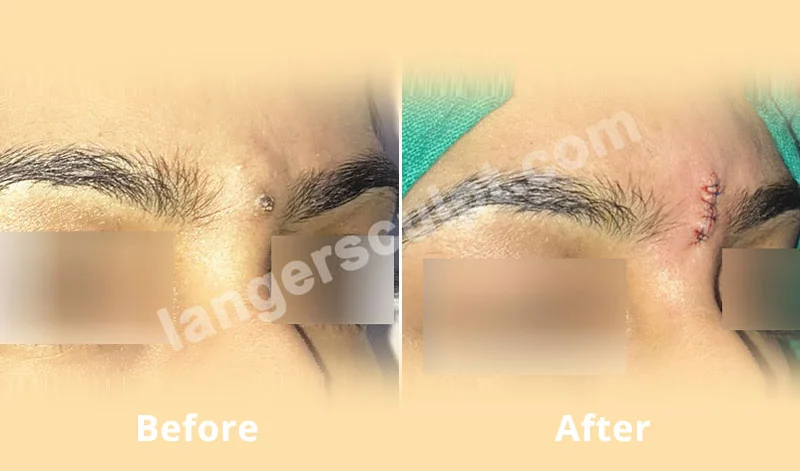 Cyst Removal