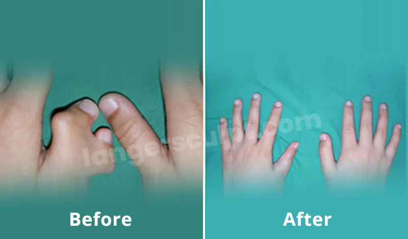 Thumb Duplication