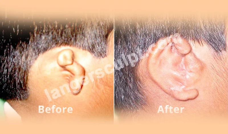 Ear Contouring