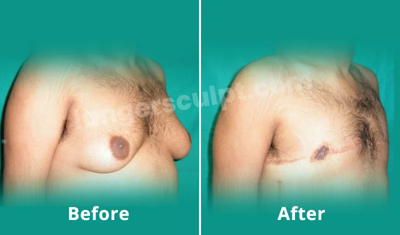 Male Breas-t Reduction 600g each side
