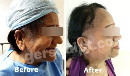 Earlobe Reduction & Repair