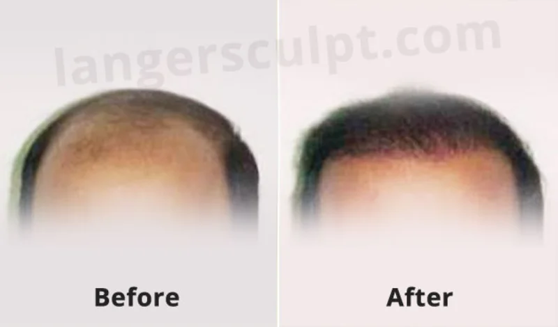 Hair Transplant