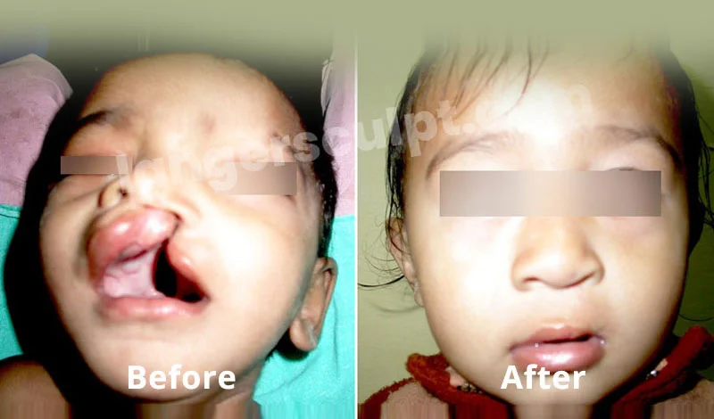 Cleft Lip