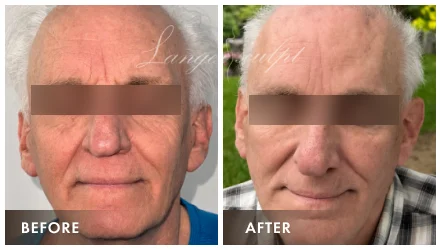 Face & Neck Lift