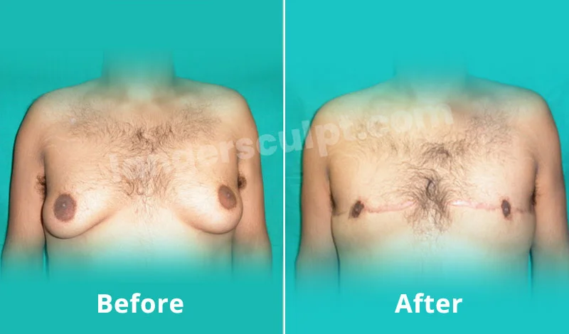 Male Breas-t Reduction 600g each side