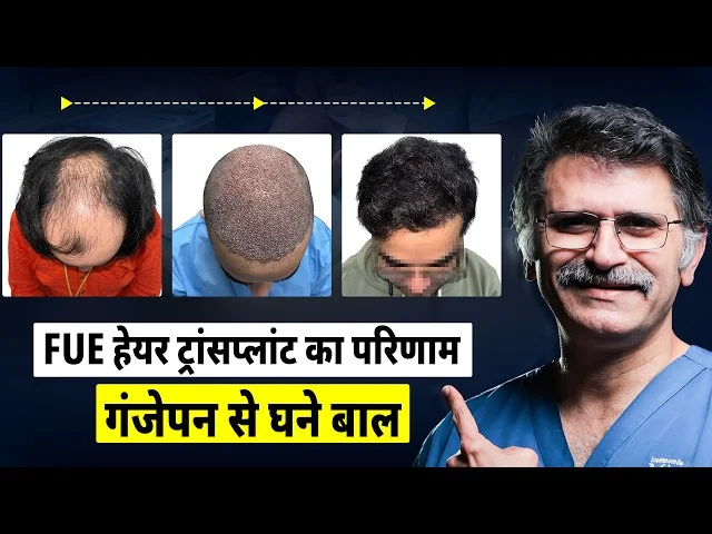 FUE Hair Transplant Explained in Hindi | Procedure, Recovery & Results Timeline | Langersculpt